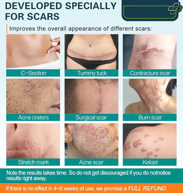 LuminaHeal Precision Scar Therapy Mist-For All Types of Scars - For example Acne Scars, Surgical Scars and Stretch Marks ⚡️⚡️⚡️