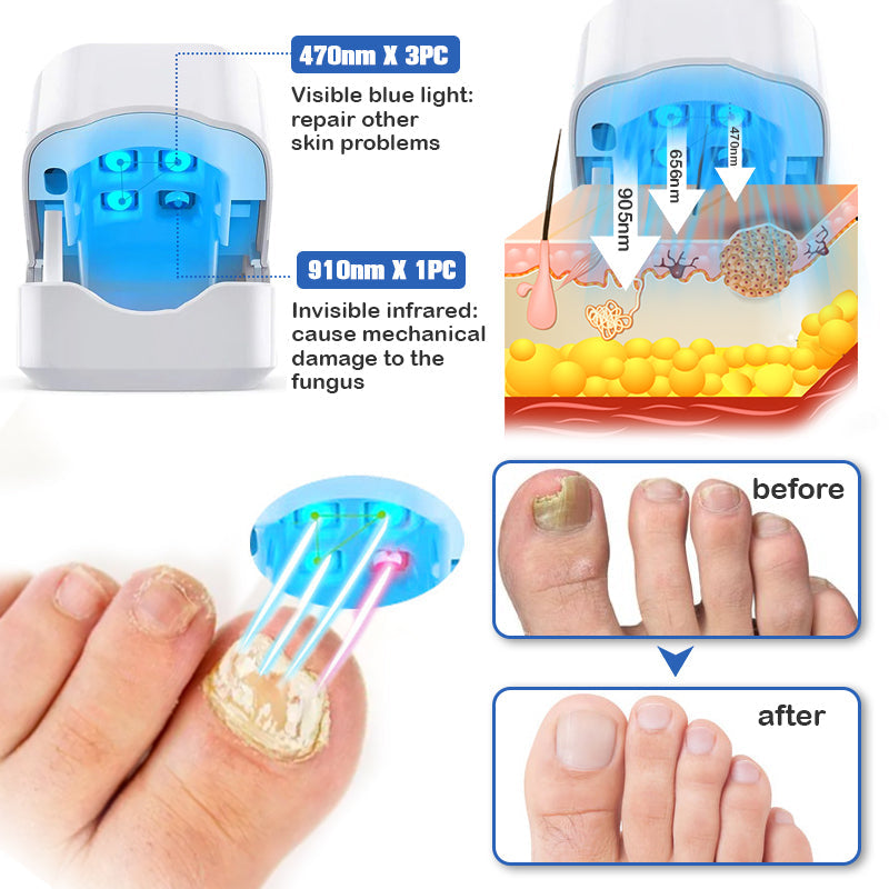 Nail Fungus Laser Therapy Device