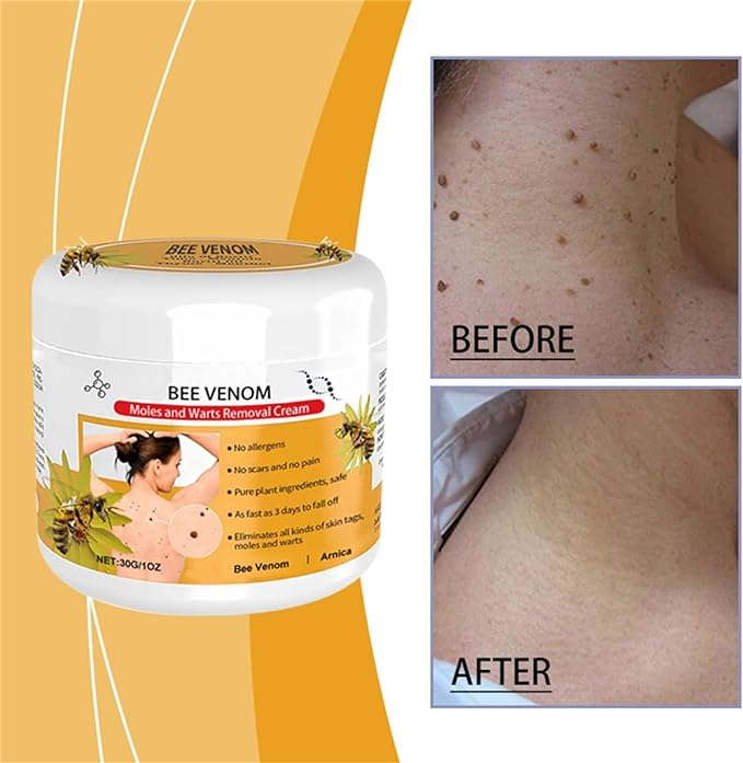 Bee Venom Mole and Wart Treatment Cream(👨‍⚕AAD RECOMMENDS)