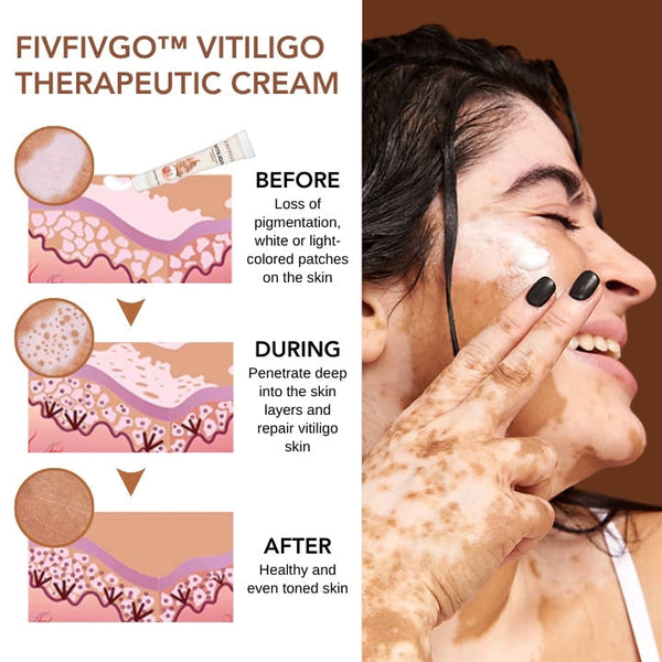 Fivfivgo™ Vitiligo Therapeutische Creme